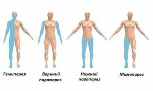 Что такое правосторонний гемипарез? Причины появления у детей и взрослых. Что такое гемипарез и гемиплегия