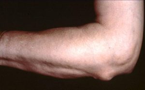 На мышце руки уплотнение. Причины появления подкожных шишек на теле человека