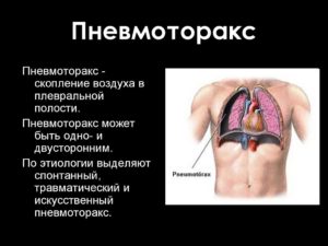 Последствия после пневмоторакса. Пневмоторакс: что это такое? Причины, симптомы и лечение пневмоторакса