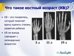 Возраст костный. Костный возраст