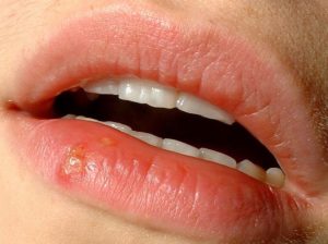 Болячка на внутренней стороне губы чем лечить. Как лечить язву внутри на губе лекарственными препаратами