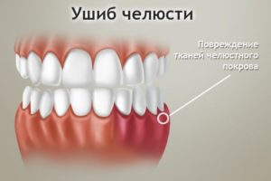 Лечение ушиба при сильном удару в челюсть. Лечение ушиба челюсти в домашних условиях