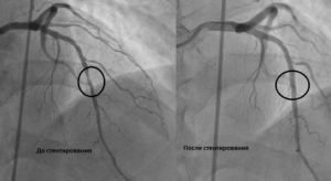 Стентирование сосудов сердца подготовка к операции. Существующий ряд неабсолютных противопоказаний. Операция стентирования сосудов сердца: что важно знать о ней