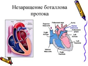 Открытый артериальный проток. Баталов проток. Незаращение Баталова протока. Врожденный порок сердца