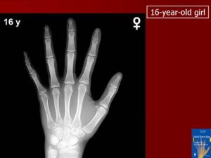 Как определить костный возраст по рентгену кисти. Определение возраста по костям