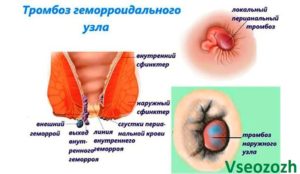 Шарик на сфинктере причины. Симптомы образования возле ануса. Общие сведения о недуге