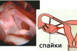 Спайки после удаления матки. Симптомы образования спаек после удаления матки