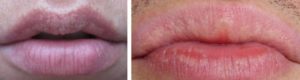 Белые пятна на губах. Что такое подкожные белые точки на губах? Причины и лечение