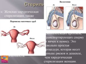 Хочу сделать стерилизацию. Женская стерилизация - стерилизация маточных труб