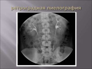 Ретроградная пиелография как проводится. Пиелография (ретроградная, внутривенная, антеградная): что это, подготовка и проведение. Показания к пиелографии