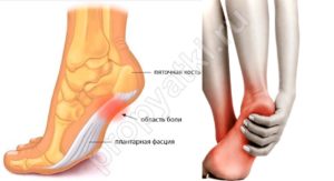 Воспаление подошвенного апоневроза лечение. Подошвенный апонероз – симптомы и лечение заболевания народными средствами. Лечебная терапия подошвенного фасциита
