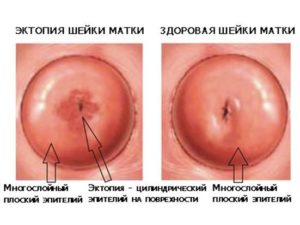 Рыхлая шейка матки что это значит. Какой должна быть здоровая шейка матки