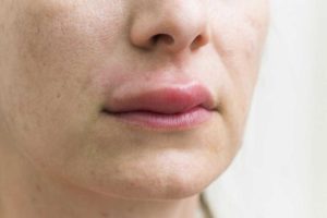 Сбоку верхняя губа опухла. Как помочь народными методами. Лечение отека у взрослых
