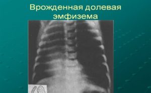 Врожденная долевая эмфизема. Интерстициальная эмфизема легких у новорожденных, симптомы и лечение. Симптомы Врожденной Долевой Эмфиземой