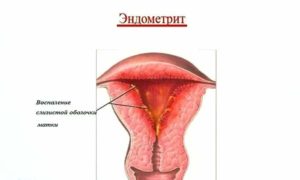 Вылечить эндометрит. Основные симптомы эндометрита. Лечебные тампоны при повышенном эндометрии матки