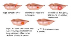 Чем лечить малярию на губах в домашних. Как быстро избавиться от малярии на губах