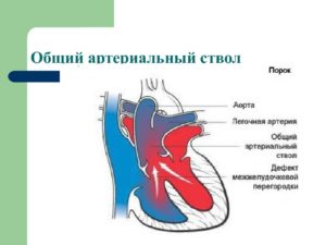 Общий артериальный ствол: описание, заболевания, лечение. Врожденные пороки сердца: общий артериальный ствол