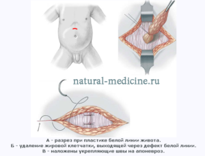 Грыжа у новорожденных и грудничков. Грыжа белой линии живота у детей: оперировать или не стоит