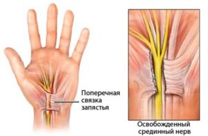 Невролиз нерва. Невролиз нерва Туннельные поражения нервов и сплетений