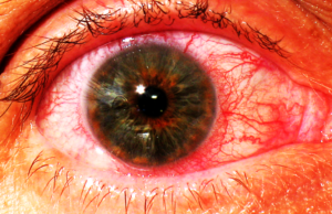 Глазное заболевание. Иридоциклит. Лечение иридоциклита. Хронический иридоциклит Острый серозный иридоциклит правого глаза