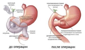 Сколько живут без поджелудочной железы. Удаление поджелудочной железы: показания к проведению, виды операции, последствия