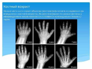Возраст костный. Костный возраст