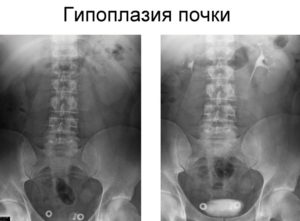 Одна почка с рождения: причины аномалии, как жить с такой патологией. Жизнь с одной почкой