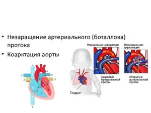 Открытый артериальный проток. Баталов проток. Незаращение Баталова протока. Врожденный порок сердца