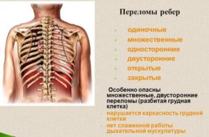 Признаки трещины в ребре на спине. Дополнительная симптоматика травм. Трещина в ребре: разновидности, симптомы, причины развития, способы лечения, профилактика