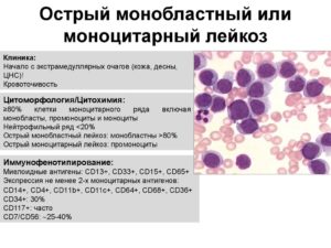 Воспаление легких при лейкозе лечение. Острый лейкоз. Акции и специальные предложения