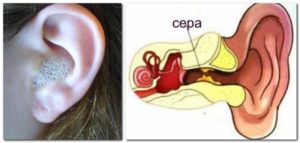 Почему в ушах у взрослого образуется много серы. Почему в ушах образуется много серы
