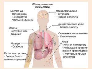 Воспаление легких при лейкозе лечение. Острый лейкоз. Акции и специальные предложения