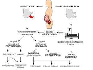 Аппендицит после родов. Острый аппендицит и беременность