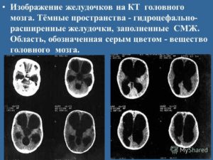 Расширение боковых желудочков мозга. Расширение желудочков головного мозга: последствия увеличения и асимметрии у новорожденных и грудничков