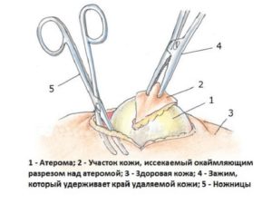 Какие могут возникать осложнения после удаления атеромы? Атерома: последствия операции и правильный уход