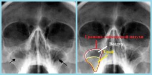 Флюорография носовых пазух. Что показывает рентген носа? Важные симптомы, на которые следует обратить внимание