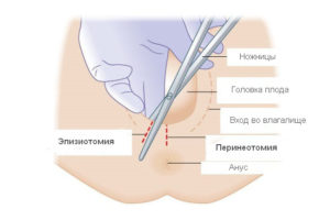 Эпизиотомия как ухаживать за швами. Эпизиотомия при родах: техника, виды, заживление