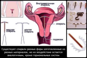 ВМС спираль: побочные действия, отзывы. Женское здоровье