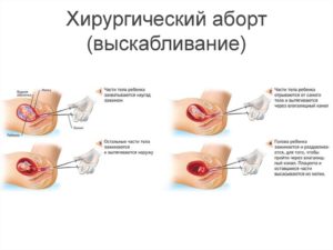 До какого срока делают вакуумный аборт, как он проходит, каковы последствия прерывания беременности? Вакуумное прерывание беременности: сроки и отзывы