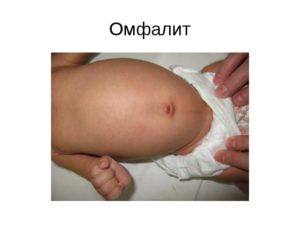 Пупочный свищ у ребенка симптомы и лечение. Пупочный свищ у грудничка: причины и стадии заболевания, а также методы лечения