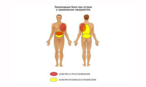 Поджелудочная как причина болей в спине. Как болит поджелудочная железа