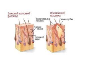 Воспалился волосяной фолликул. Прыщи в волосяных луковицах. Провоцирующие факторы заболевания