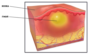 Фурункул лечение луком. Что сделать, чтобы нарыв быстрее прорвался