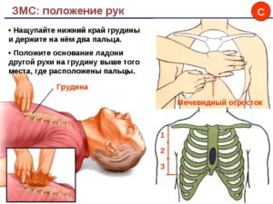 Почему болит мечевидный отросток при нажатии. Мечевидный отросток грудины увеличился