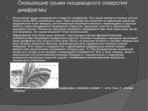 Скользящая диафрагмальная грыжа. Причины появления скользящей кардиальной грыжи и ее лечение. Диета и питание