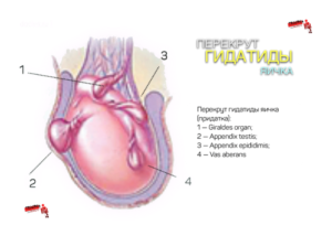 Перекрут гидатиды яичка: что это такое, диагностика заболевания, лечение. Причины возникновения и лечение гидатиды яичника