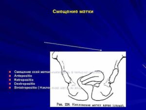 Смещение матки при беременности немного влево. Смещение матки