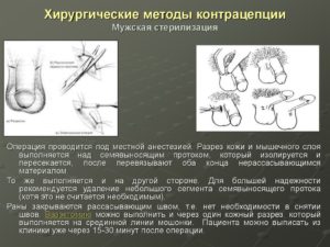 Мужская стерилизация. Преимущества и недостатки стерилизации мужчины (с ценами и отзывами)