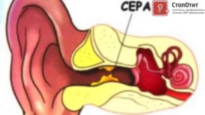 Почему ушная сера сухая? Что такое ушная сера и зачем она нужна