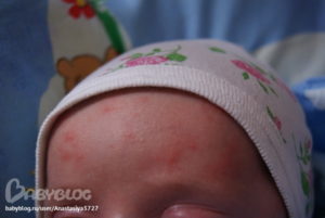 Лавровый лист при раздражении и аллергии у грудничка. Купание новорожденного в лавровом листе